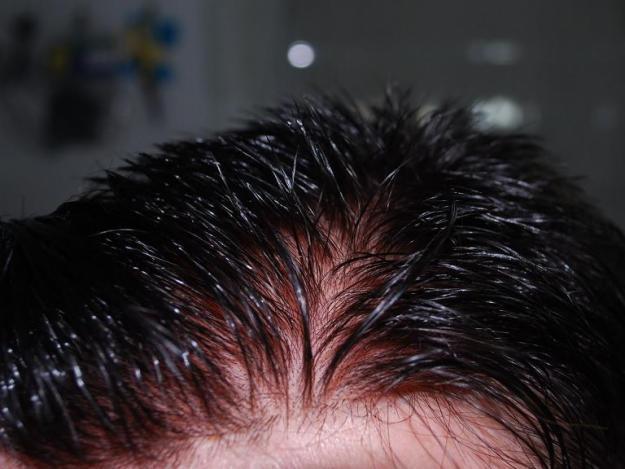 Calvicie, alopecia areata, caida de cabellos? protesis capilares new gen Madrid